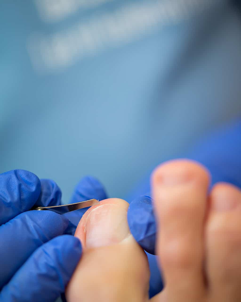 Behandling af negleprotese med skalpel