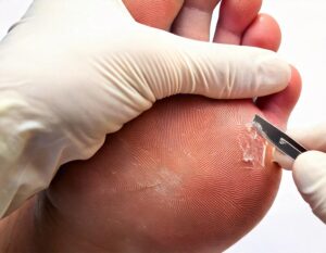 Fod med ligtorne (clavus durus), bliver skåret væk med skalpel